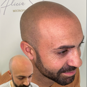 Micropigmentacion-Capilar-3.png